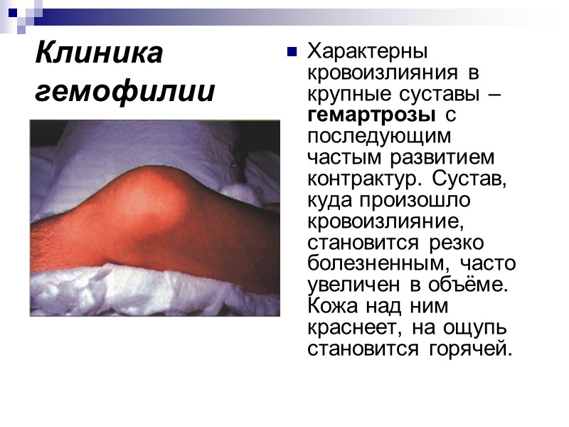 Клиника гемофилии Характерны кровоизлияния в крупные суставы – гемартрозы с последующим частым развитием контрактур.